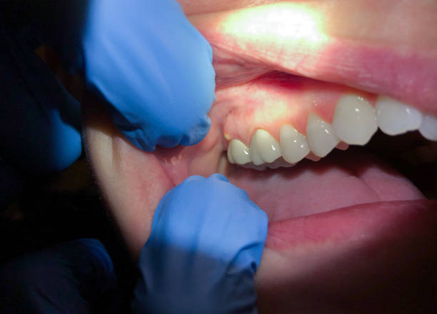 Best Lost Filling or Crown Replacement in Steger, IL